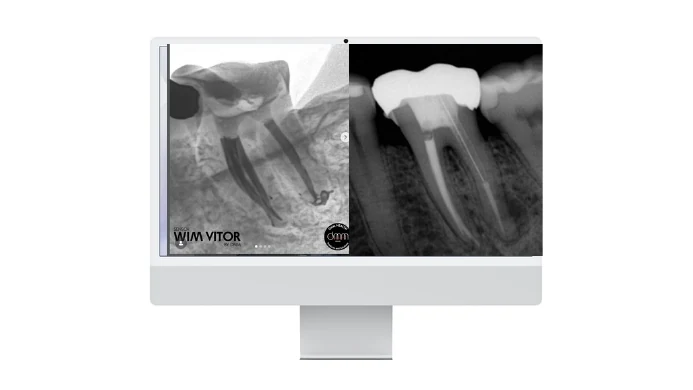 Monitor com radiografias digitais de tratamentos endodônticos